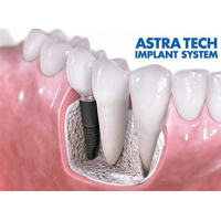 Имплантационная система Astra Tech