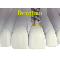 Имплантационная система Dentium